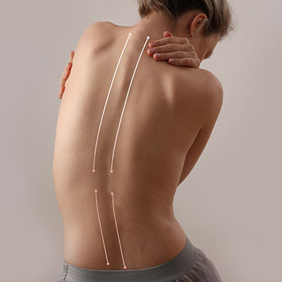 Scoliosis specialist in Bay Area