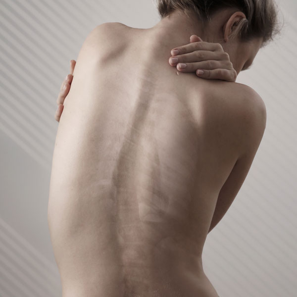 The Reality of Living with a Curvature of the Spine